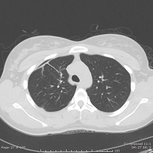 Catamenial pneumothorax (Radiopaedia 54382-60600 Axial non-contrast 27).jpg