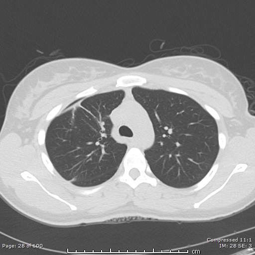 Catamenial pneumothorax (Radiopaedia 54382-60600 Axial non-contrast 28).jpg