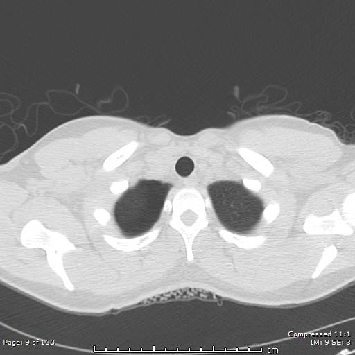 File:Catamenial pneumothorax (Radiopaedia 54382-60600 Axial non-contrast 9).jpg