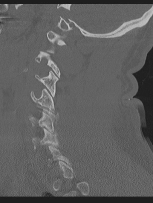 Cavernoma of cervical cord (Radiopaedia 50838-56346 Sagittal bone window 57).png