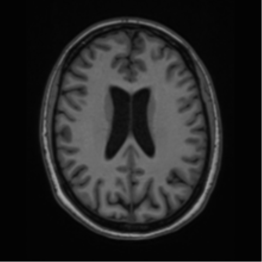 Cavernoma with bleed - midbrain (Radiopaedia 54546-60774 Axial T1 31).png