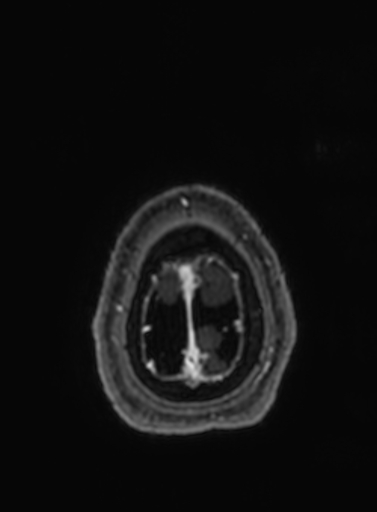 Cavernous hemangioma of the cerebellar falx (Radiopaedia 73025-83724 Axial T1 C+ 23).jpg