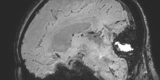 Cavernous hemangioma of the cerebellar falx (Radiopaedia 73025-83724 Sagittal BOLD 110).jpg