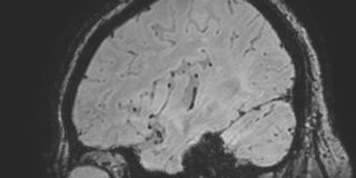 File:Cavernous hemangioma of the cerebellar falx (Radiopaedia 73025-83724 Sagittal BOLD 45).jpg