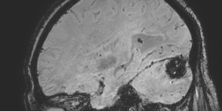 Cavernous hemangioma of the cerebellar falx (Radiopaedia 73025-83724 Sagittal BOLD 64).jpg