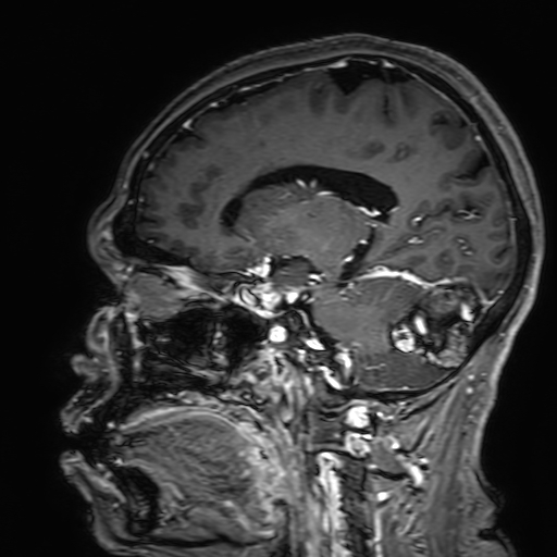 Cavernous hemangioma of the cerebellar falx (Radiopaedia 73025-83724 Sagittal T1 C+ 128).jpg