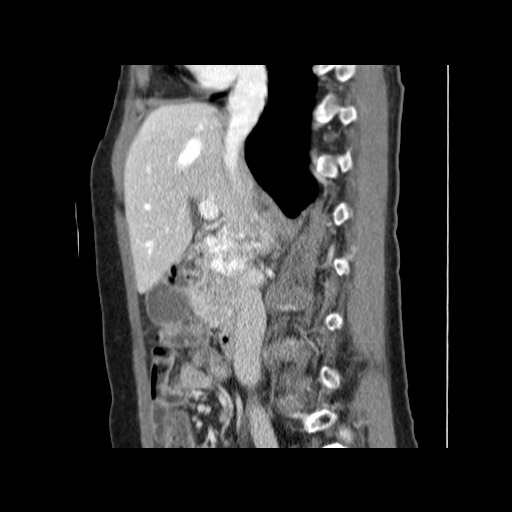Cavernous hepatic hemangioma (Radiopaedia 75441-86667 D 81).jpg