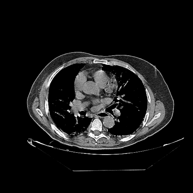 Cavitating bronchogenic carcinoma (Radiopaedia 44489-48162 Axial non-contrast 44).jpg