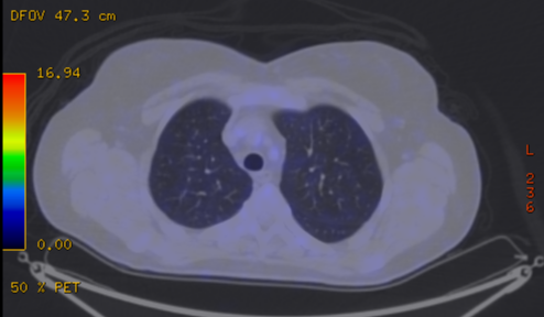 File:Cavitating lung mass - squamous cell carcinoma (Radiopaedia 48047-52853 A 27).png
