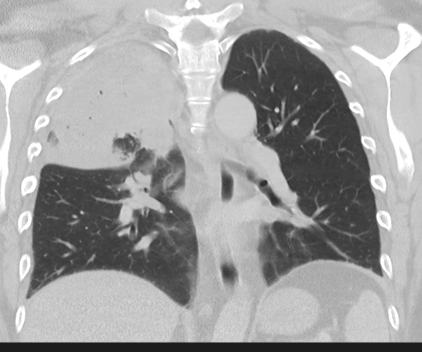 File:Cavitating pneumonia (Radiopaedia 45998-50329 Coronal lung window 31).png