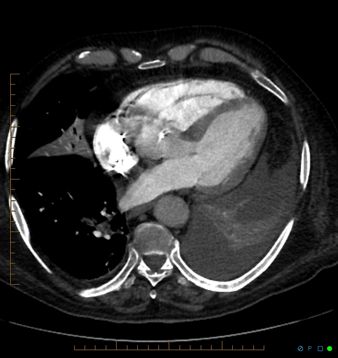 Cavitating pulmonary infarction (Radiopaedia 54634-60849 Axial C+ CTPA 56).jpg