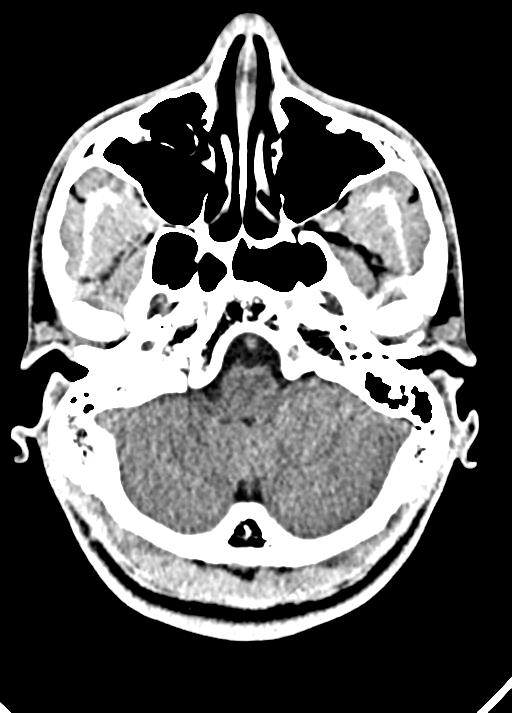 Cavum septum pellucidum and cavum vergae (Radiopaedia 77797-90060 Axial Brain Window 19).jpg