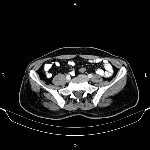 Cecal adenocarcinoma (Radiopaedia 85324-100916 B 69).jpg