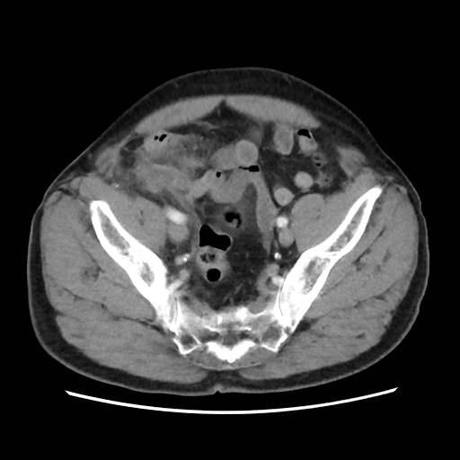 Cecal mass causing appendicitis (Radiopaedia 59207-66531 A 72).jpg