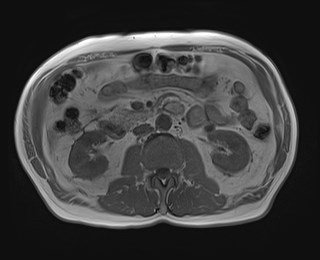 File:Cecal mass causing appendicitis (Radiopaedia 59207-66532 Axial T1 in-phase 64).jpg