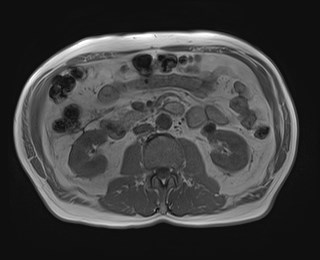 Cecal mass causing appendicitis (Radiopaedia 59207-66532 Axial T1 in-phase 65).jpg