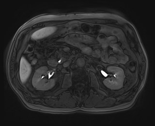 Cecal mass causing appendicitis (Radiopaedia 59207-66532 K 57).jpg