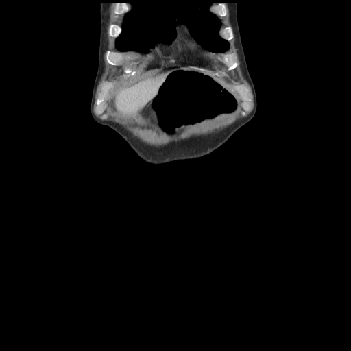 Cecal volvulus (Radiopaedia 89212-106088 E 4).jpg