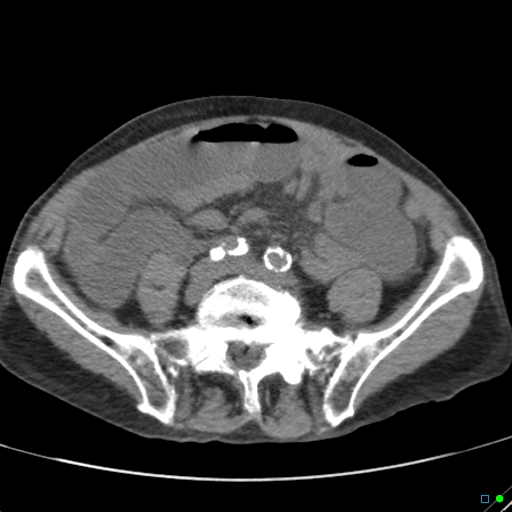 Cecal volvulus - atypical (Radiopaedia 21637-21588 non-contrast 48).jpg
