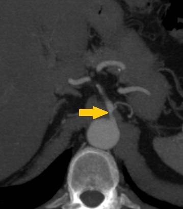 File:Celiac artery compression by the diaphragmatic crurae (Radiopaedia 31739-32667 Axial CTA 1).jpg