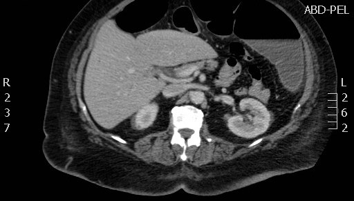 File:Celiac artery compression syndrome (Radiopaedia 24287-24570 B 25).jpg
