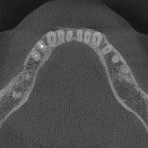 Cemento-osseous dysplasia (Radiopaedia 48251-53126 Axial non-contrast 36).jpg