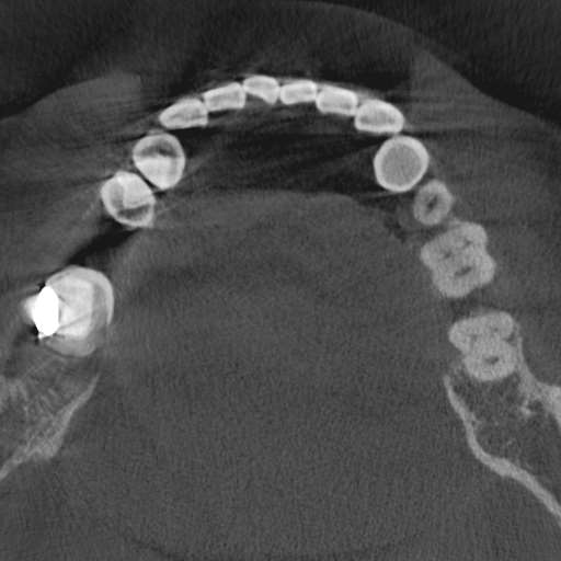 Cemento-osseous dysplasia (Radiopaedia 48251-53126 Axial non-contrast 58).jpg