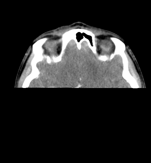 File:Cemento-ossifying fibroma (Radiopaedia 46243-50643 Axial C+ delayed 11).png