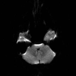 File:Central-variant posterior reversible encephalopathy syndrome (PRES) (Radiopaedia 43880-47358 Axial DWI 5).jpg