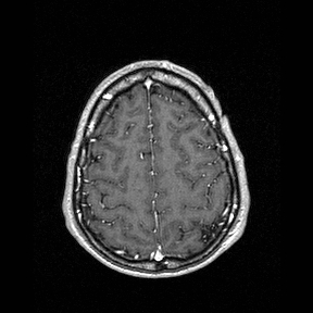 Central-variant posterior reversible encephalopathy syndrome (PRES) (Radiopaedia 43880-47358 Axial T1 C+ 138).jpg