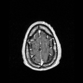 Central-variant posterior reversible encephalopathy syndrome (PRES) (Radiopaedia 43880-47358 Axial T1 C+ 155).jpg