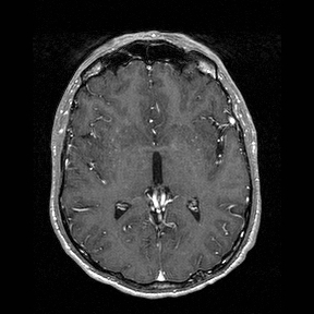 File:Central-variant posterior reversible encephalopathy syndrome (PRES) (Radiopaedia 43880-47358 Axial T1 C+ 80).jpg