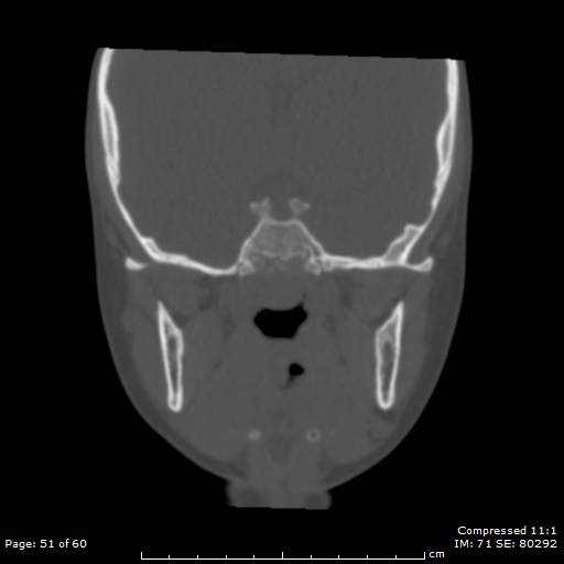 Central giant cell granuloma (Radiopaedia 45612-49754 Coronal bone window 51).jpg