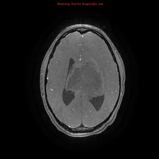 Central neurocytoma (Radiopaedia 13188-13206 Axial MRA 9).jpg