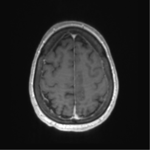 Central neurocytoma (Radiopaedia 65317-74345 Axial T1 C+ 49).png
