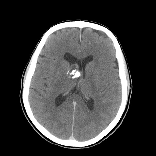 File:Central neurocytoma (Radiopaedia 68725-78432 Axial C+ 46).jpg