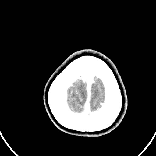 Central neurocytoma (Radiopaedia 84497-99871 B 48).jpg