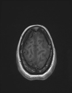 Central neurocytoma (Radiopaedia 84497-99872 Axial T1 167).jpg