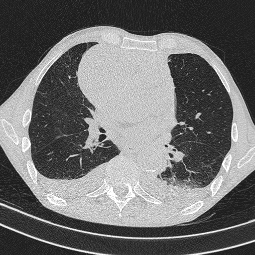 Central venous catheter tip extravasation (Radiopaedia 82828-97113 Axial lung window 47).jpg