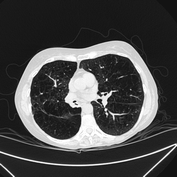 Centrilobular pulmonary emphysema (Radiopaedia 24495-24789 Axial lung window 50).jpg