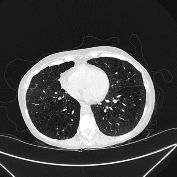 Centrilobular pulmonary emphysema (Radiopaedia 24495-24789 Axial lung window 65).jpg