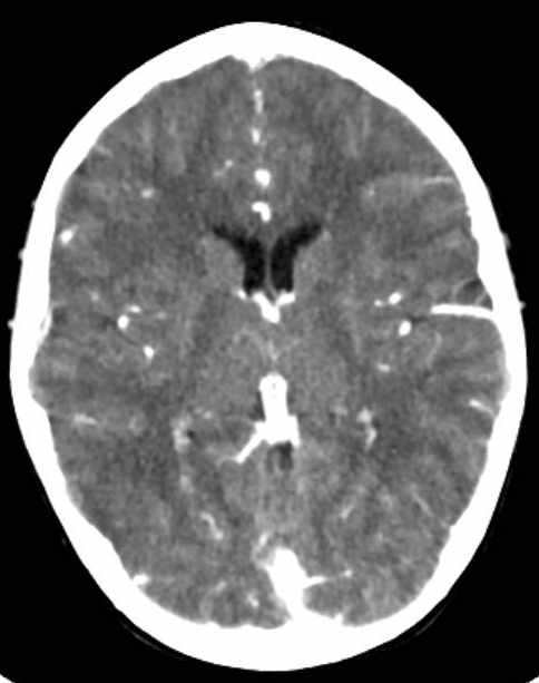 Cerebellar abscess (Radiopaedia 73727-84527 Axial C+ 45).jpg
