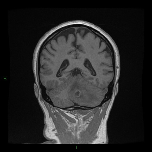 File:Cerebellar abscess (Radiopaedia 78135-90678 Coronal T1 C+ 113).jpg