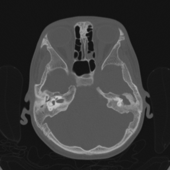 Cerebellar abscess secondary to mastoiditis (Radiopaedia 26284-26413 Axial bone window 58).jpg