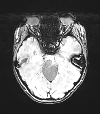 Cerebellar agenesis with hypoplastic pons (pontocerebellar hypoplasia) (Radiopaedia 57224-64138 Axial SWI 34).png