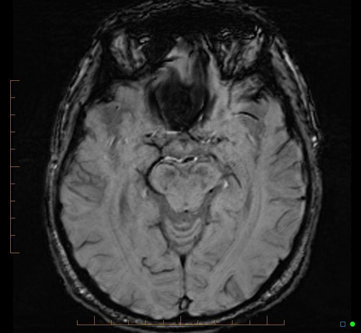 Cerebellar gangliocytoma (Radiopaedia 65377-74422 Axial SWI 24).jpg