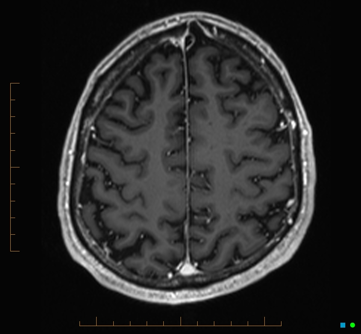 Cerebellar gangliocytoma (Radiopaedia 65377-74422 Axial T1 C+ 109).jpg
