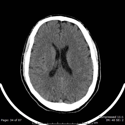 Cerebellar hemangioblastoma (Radiopaedia 52360-58258 Axial non-contrast 34).jpg