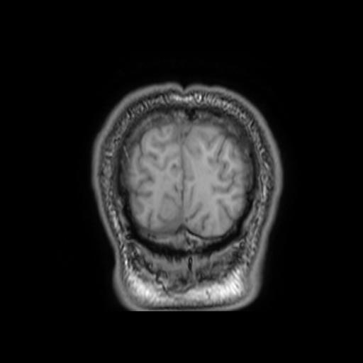 File:Cerebellar hemangioblastoma (Radiopaedia 88055-104622 Coronal T1 34).jpg