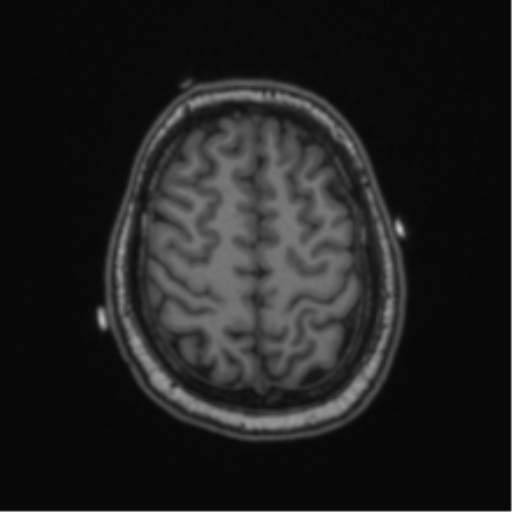 Cerebellar hemangioblastomas and pituitary adenoma (Radiopaedia 85490-101176 Axial T1 59).png